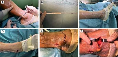 The clinical outcomes of surgical treatment for chronic ankle instability by anatomical reconstruction of the anterior talofibular ligament with autologous half-bundle peroneal longus tendon: A retrospective study